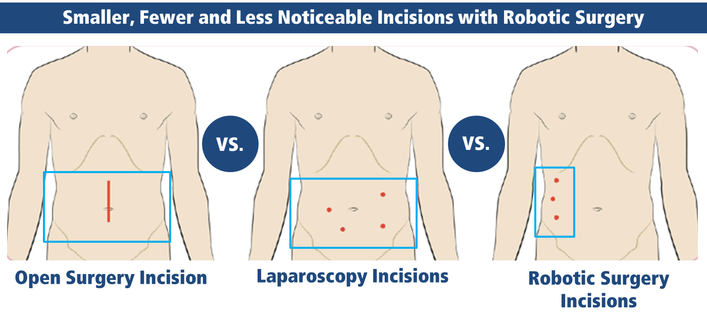 Robotic Hernia Surgery